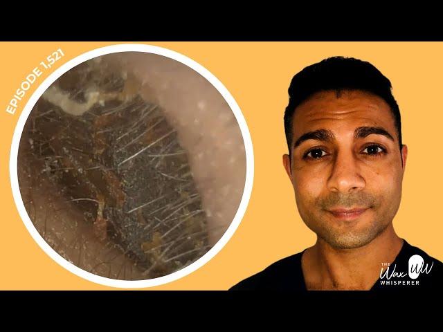1,521 - Fleshy Granulation Tissue Removed Whilst Performing Ear Wax Removal