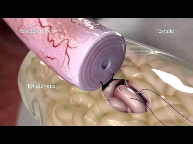 Epididymovasostomy - Mayo Clinic