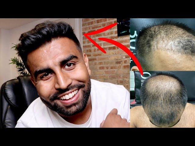 7 MONTH TURKEY HAIR TRANSPLANT UPDATE | PHASE 2