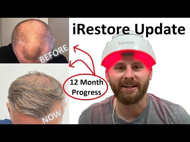 IRESTORE LASER HAIR GROWTH THERAPY 12 - MONTH UPDATE | Before and After Comparison