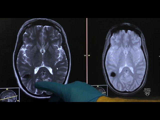 Cavernous malformations — Neurovascular disease explained