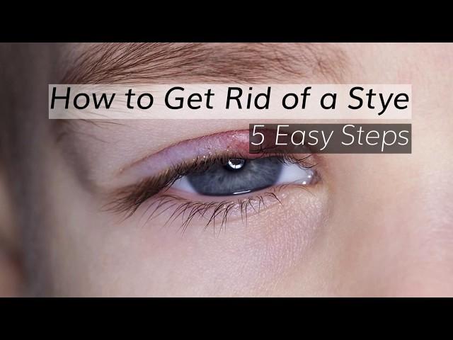 Eye Stye Treatment: How to Get Rid of A Stye in 5 Steps