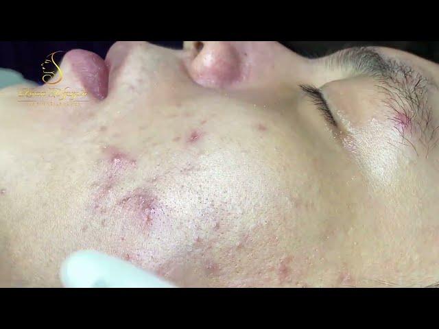 Loan Nguyen Acne Treatment 16911