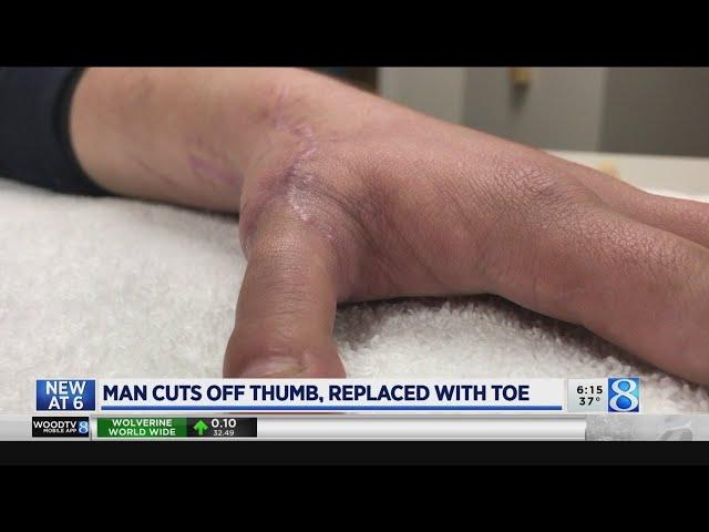 Doctors use man’s toe to recreate sawed-off thumb