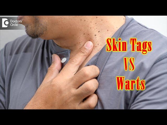 What Causes Skin Tags And Warts? | Get Rid of Warts & Skin Tags- Dr. Renuka Shetty | Doctors' Circle