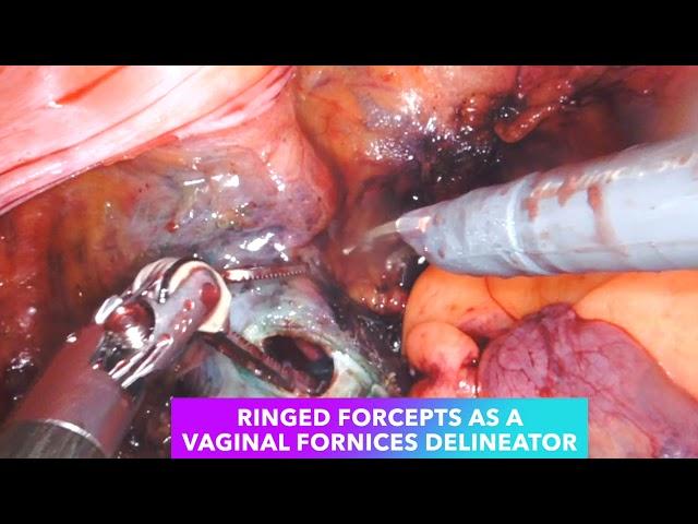 Ringed Forcepts Vaginal Fornix Delineation