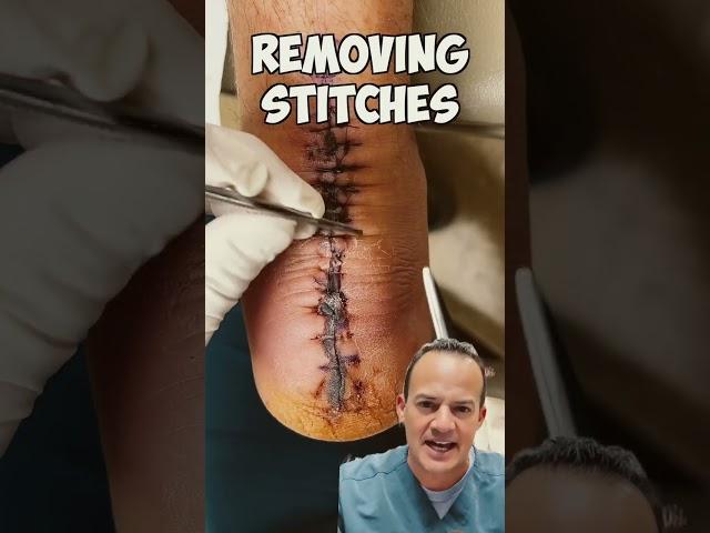 DOCTOR REACTS: REMOVING STITCHES!  #shorts #satisfying