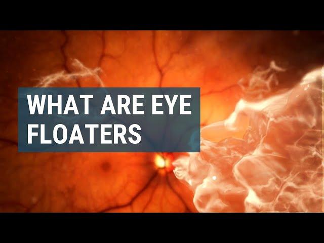 What Are Eye Floaters