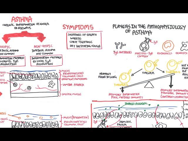 Asthma - signs and symptoms, pathophysiology