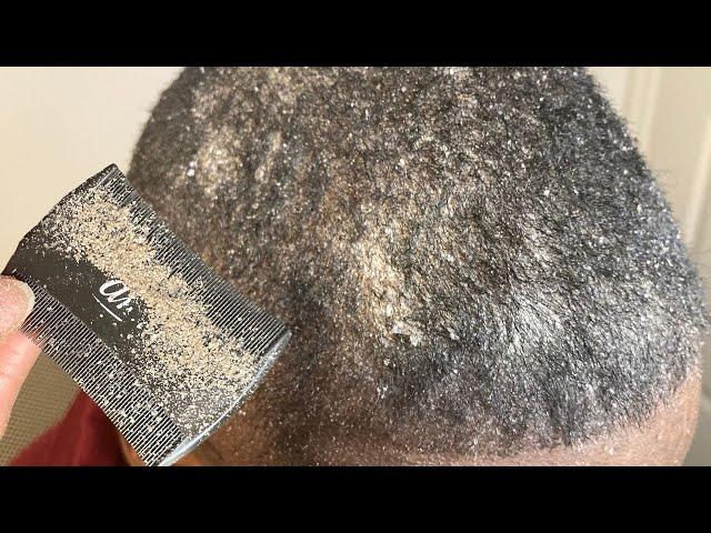 Close up Scalp Cleanse ASMR. We Scratch. You Relax