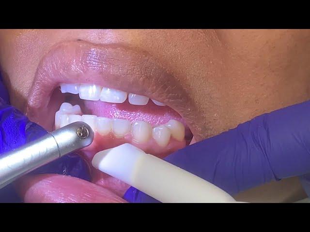 Houston Cosmetic Dentist...Quick Laser procedure to show less gum when you smile...