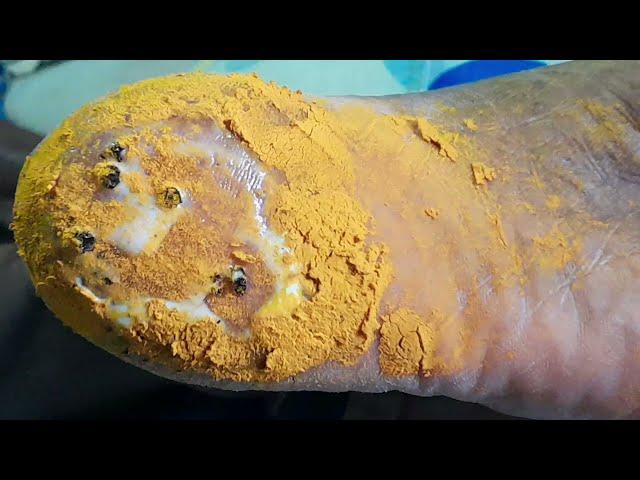 Crusty Foot callus with lot of wounds | Removal of dead skin and scrape callus so satisfying