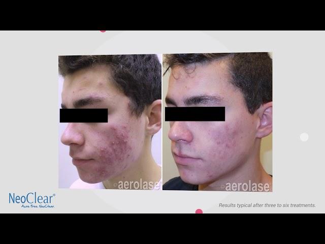 NeoClear by Aerolase - Patient Seeking Acne Laser Treatments