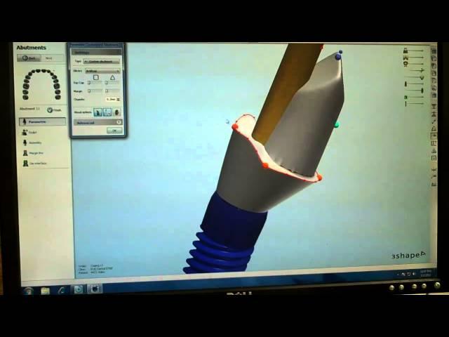 ROE CAD CAM Crown + Abutment