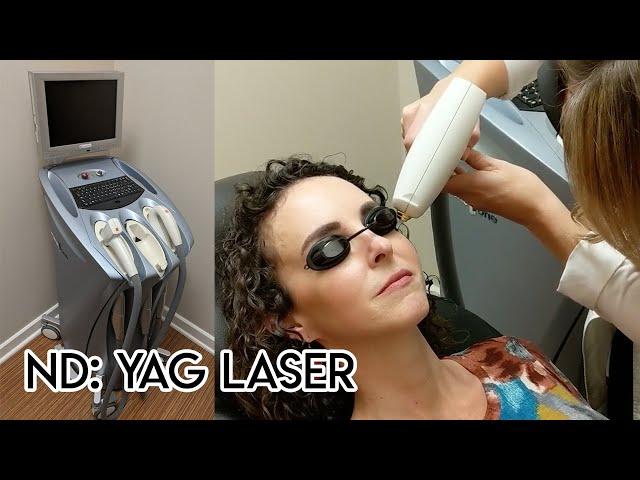 ND: Yag Laser