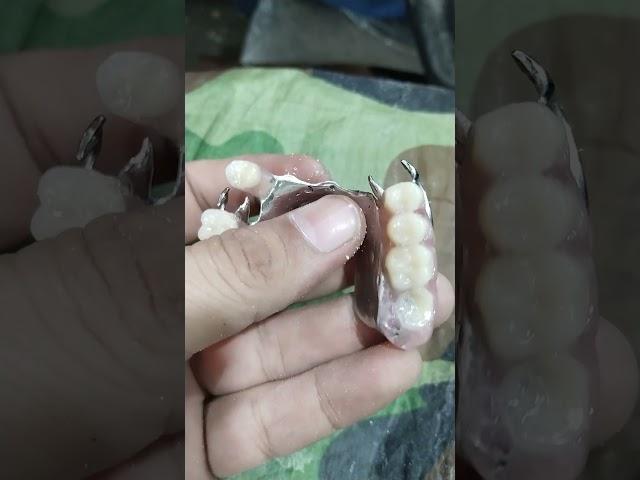 Cost Partial Denture 