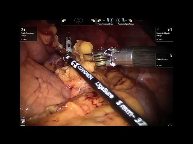 Indications for Pancreatic Resection and Robotic Surgical Technique | Brigham and Women's Hospital