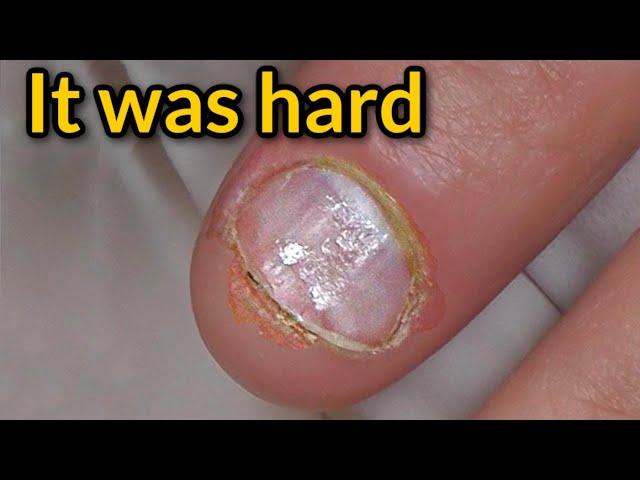 Extremely Bitten & Oily Nails Transformation | Readyhubb Overview