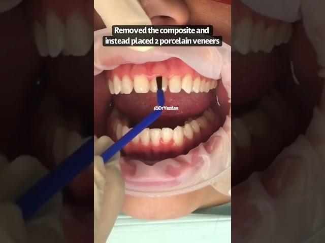 Composite bonding vs. porcelain veneers | porcelain veneers procedure | dental veneer before after