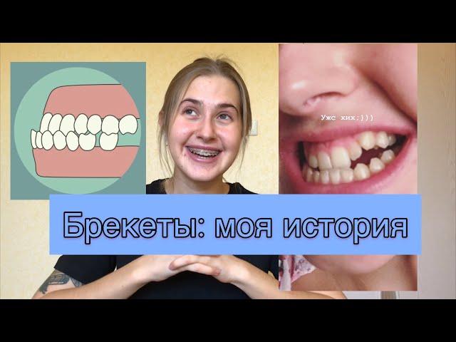 Брекеты: моя история. Почему не ставили? Прикус, члх и винты