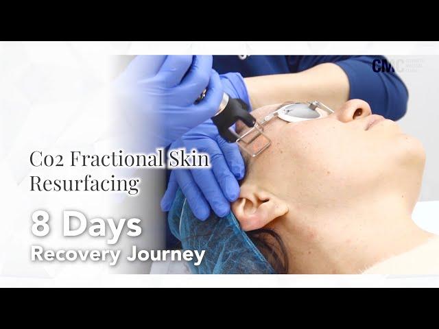 Co2 Laser Fractional Skin Resurfacing 8 Day Recovery Journey  | Before&After | CMC NSW