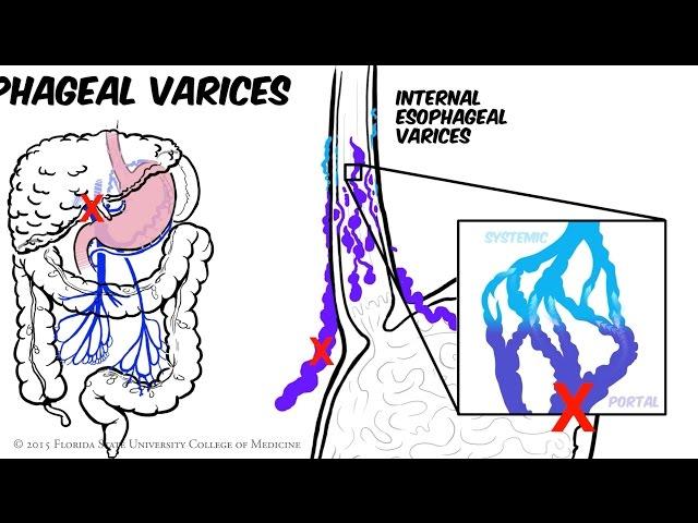 Portal Hypertension: Animated Review