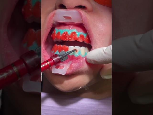 NEW Teeth Whitening Procedure at View Mobile Dental | Arnold Paulos DDS