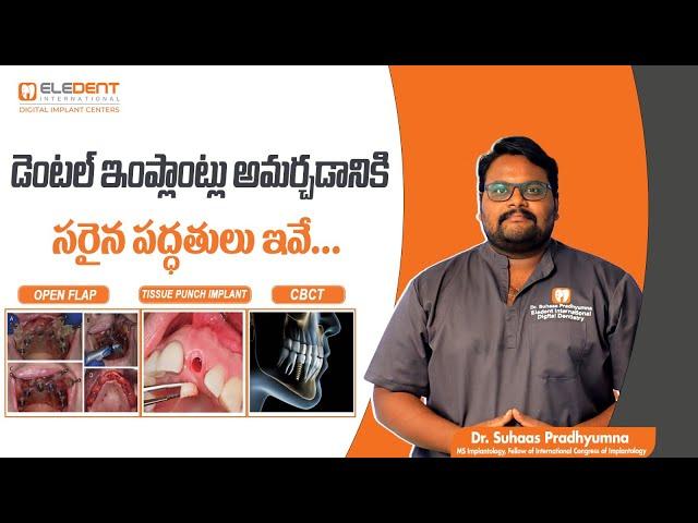 The 3 Types of Dental Implant Placement Explained | Dental care in Telugu | Eledent Dental Hospitals