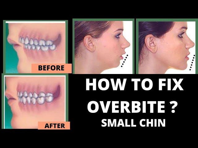 HOW TO FIX OVERBITE & Small chin + WITH NO BRACES