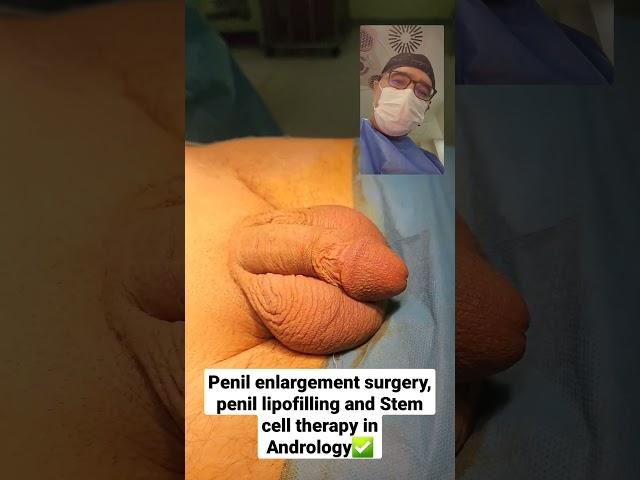 Penil enlargement surgery, Penil lipofilling and Stem cell therapy in Andrology Dr Araz Bayramov