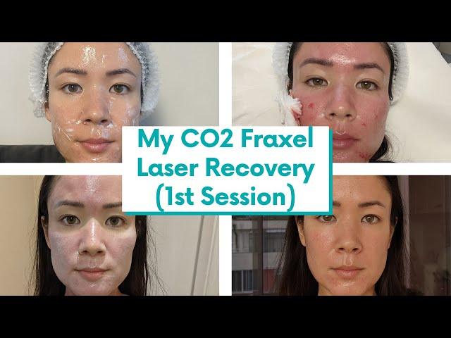 I FINALLY Got CO2 Fraxel Laser for my Atrophic Acne Scars! Recovery Vlog | @michxmash