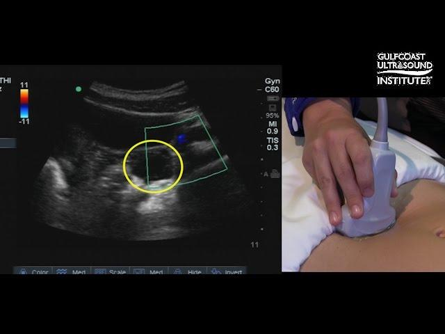 Hot Tips - Locating the Ovaries on Transabdominal Ultrasound