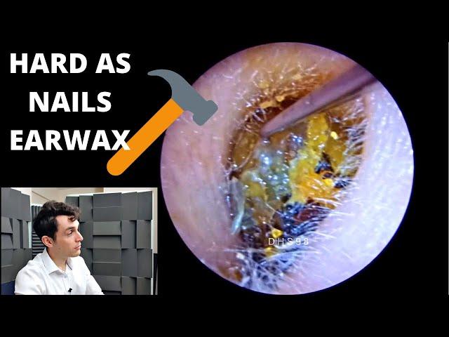 HARD AS NAILS Ear Wax VS Cawthorne Hook