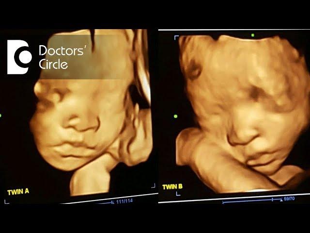 When is the best time to have 3D 4D ultrasound with twins?-Dr. Shoba Venkat of Cloudnine Hospitals