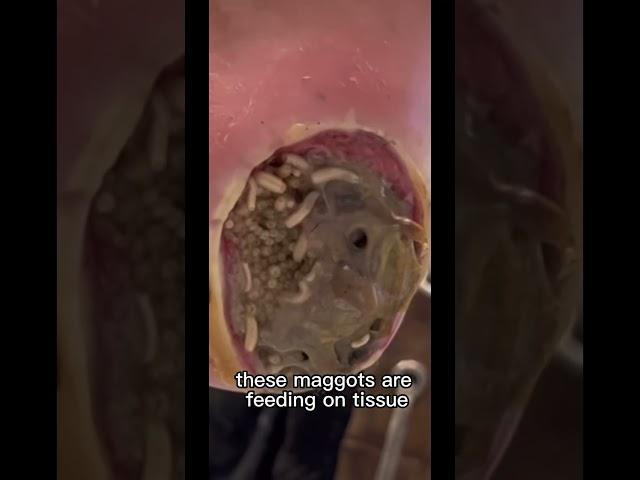 FOOT INVADED WITH MAGGOTS