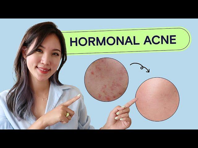 How To Treat Hormonal Acne | Acne School EP03 Health