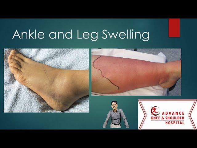 Top 10 causes of Ankle and Leg Swelling