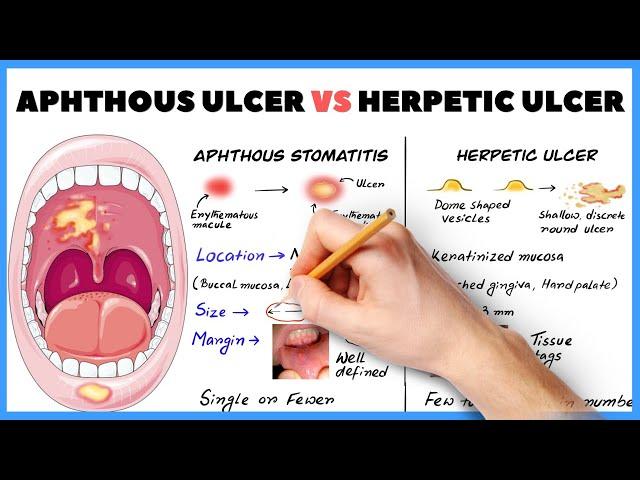 Aphthous ulcer (Aphthous stomatitis) vs Herpetic ulcer : How to diagnose