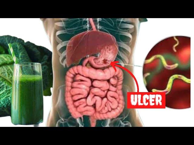 Fast and Easy Way To Heal An Ulcer With Cabbage Juice