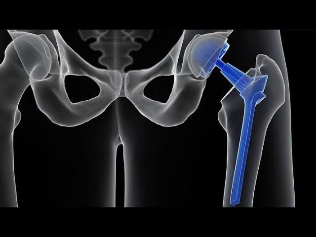 TOTAL HIP REPLACEMENT SURGERY! #thr #ottechnicianwork #ot #ottechnician