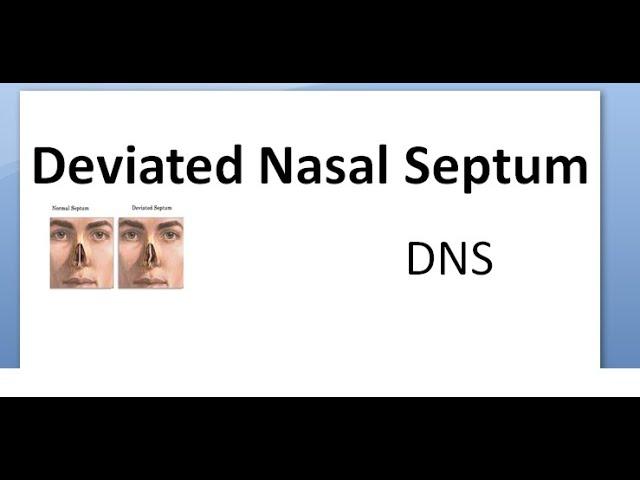 ENT Deviated Nasal Septum DNS Why do I have deviation of nose Causes Types treatment