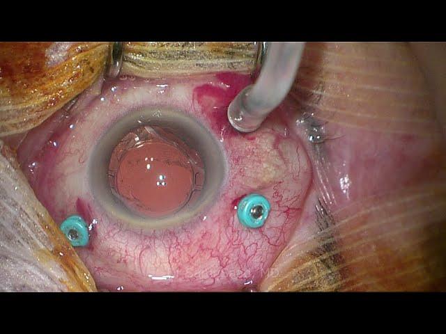 Superior bullous retinal detachment & Air tamponade - Dr Sami A. Saad narrated by Dr A. Aziria