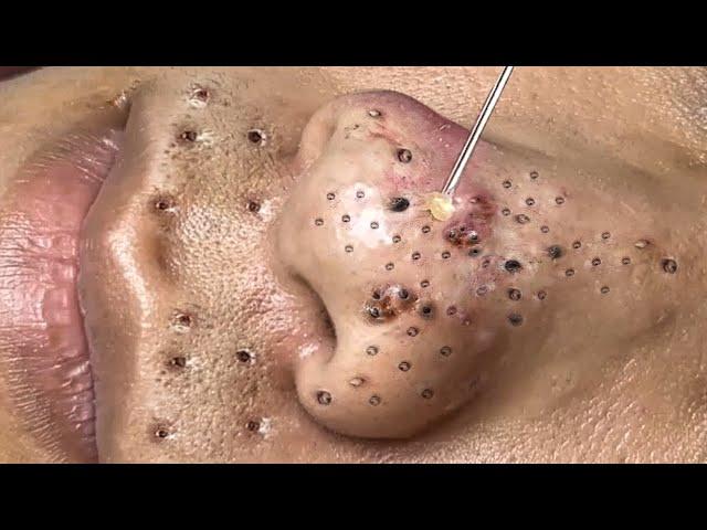 Blackhead Removal With Sac Dep Spa @100074126