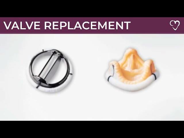 Heart Valve replacement