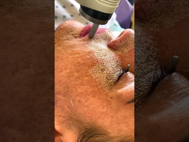 Melhorando a Flacidez da pele, rejuvenescimento a laser na @helltatto com @LumenisAesthetics