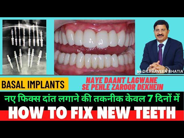 How To Fix New Teeth - LIVE- Fix Dant Kaise Lagate Hain II II Basal Implants