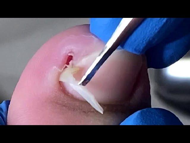 Pedicure Tutorial: Very deep ingrown nails, causing red, swollen and painful toes【Xue Yidao】