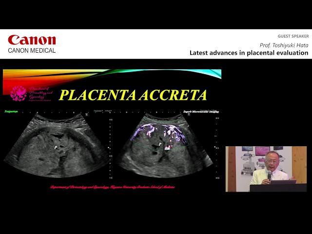 ISUOG 2018 Prof.Toshiyuki Hata - Latest Advances in Placental Evaluation