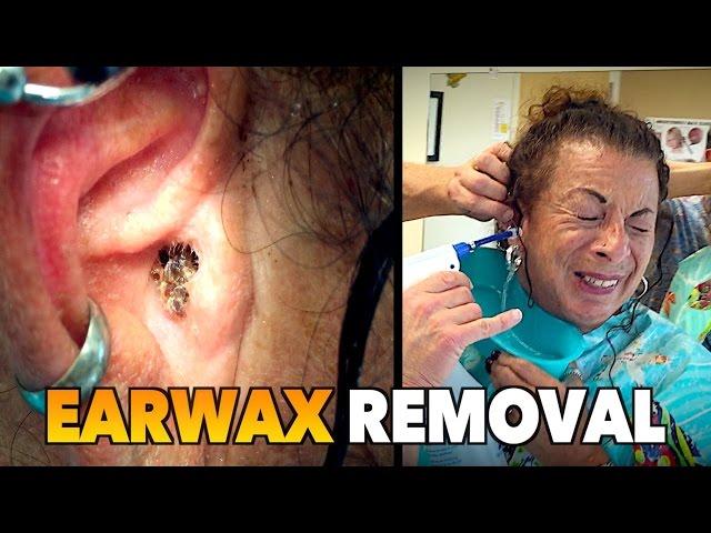 MASSIVE EARWAX REMOVAL! | Dr. Paul (feat. Maiya)