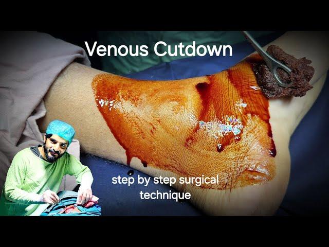 Venous Cutdown Technique - Dr Tayyab Riaz Ch